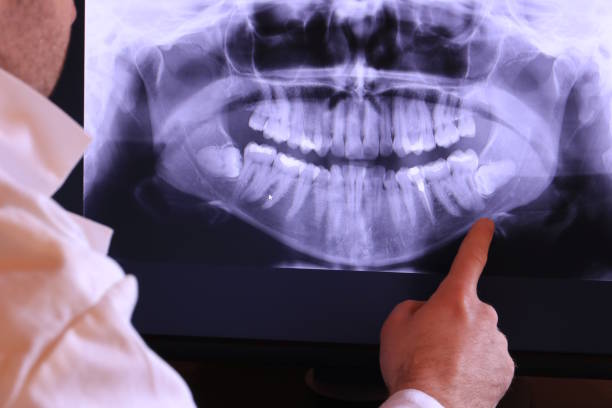 Best Emergency Wisdom Teeth Removal in Forsgate, NJ