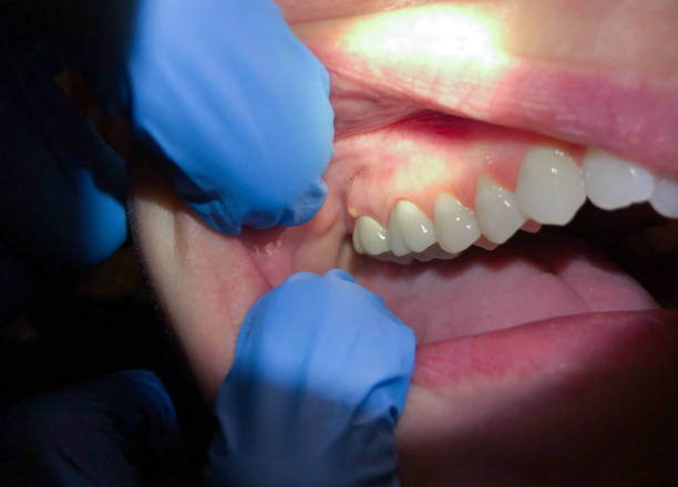 Best Emergency Treatment for Dental Infections or Abscesses in Forsgate, NJ